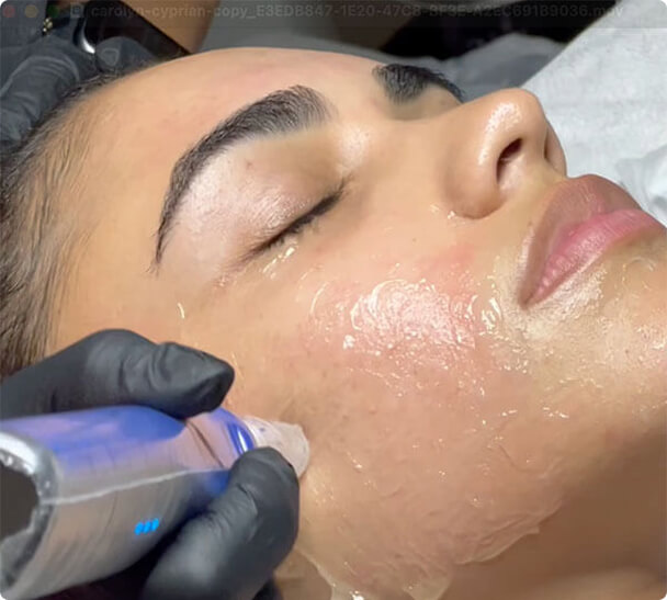 Intelligente Technologie ist das Markenzeichen von SkinPen®Precision Elite
