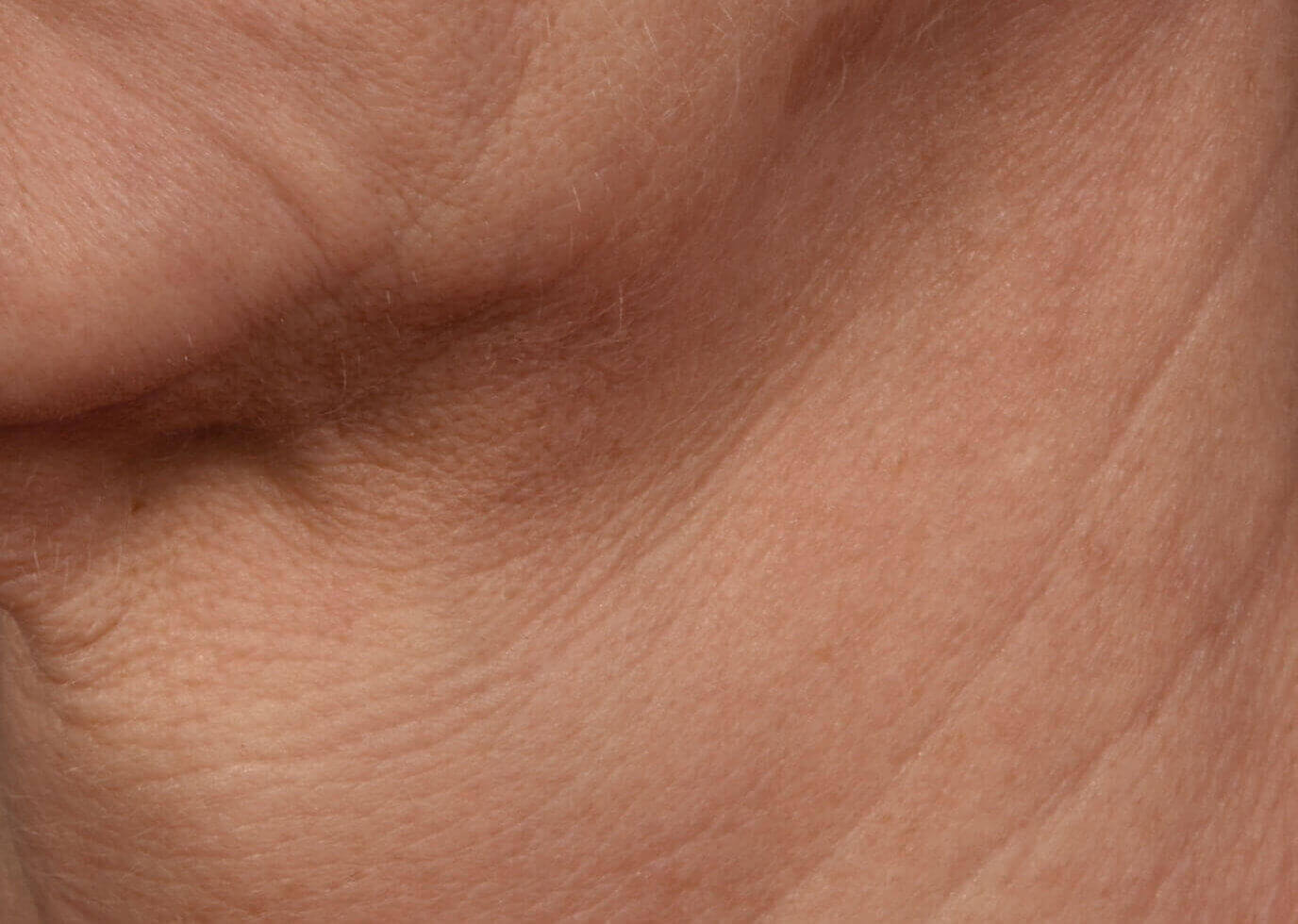 Vorher 