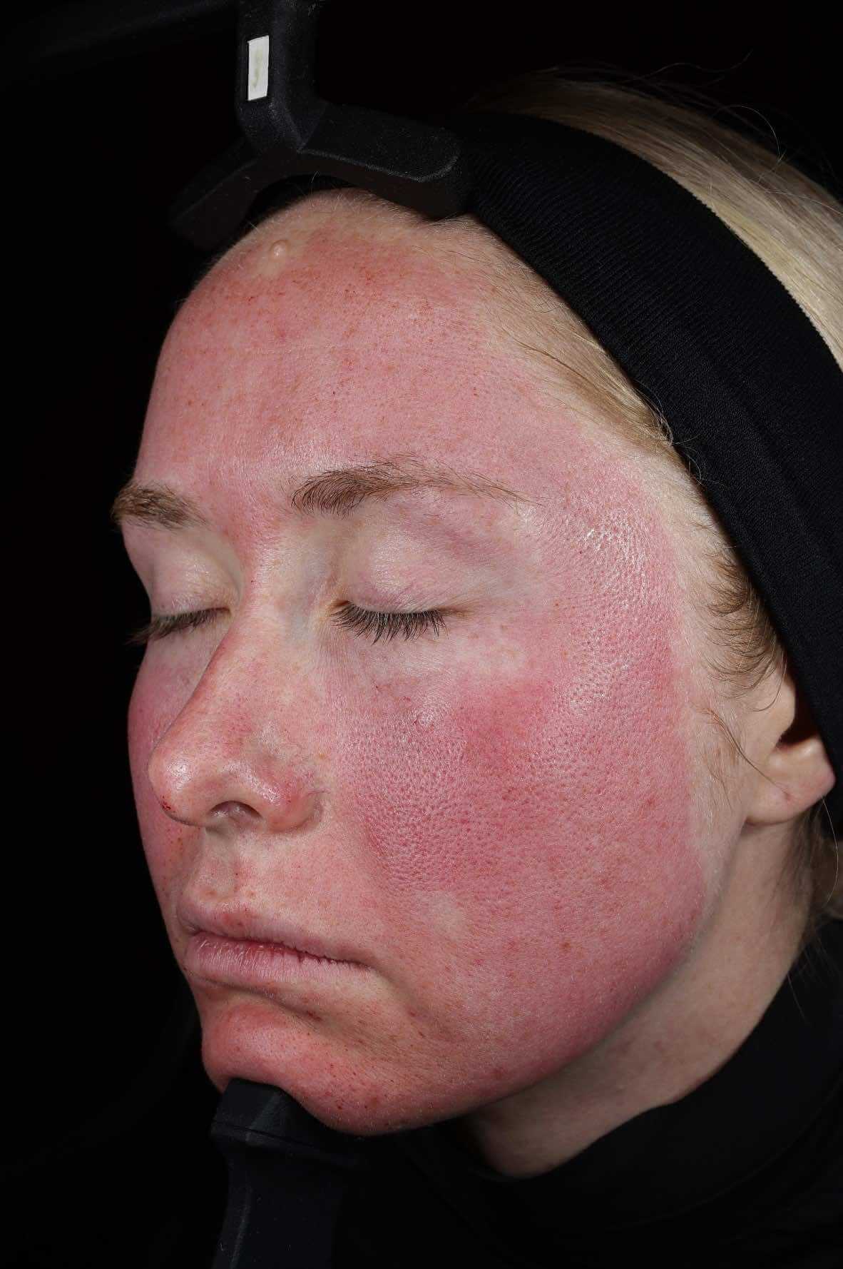 SkinPen treatment progress 4 Stunden