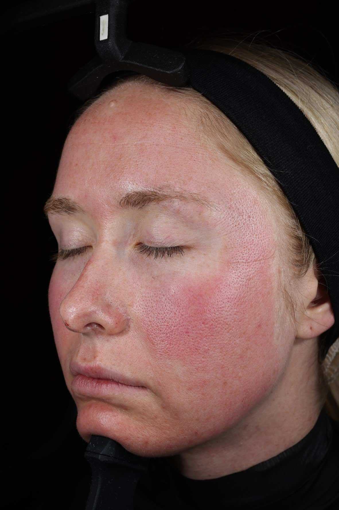 SkinPen treatment progress 1 Stunde