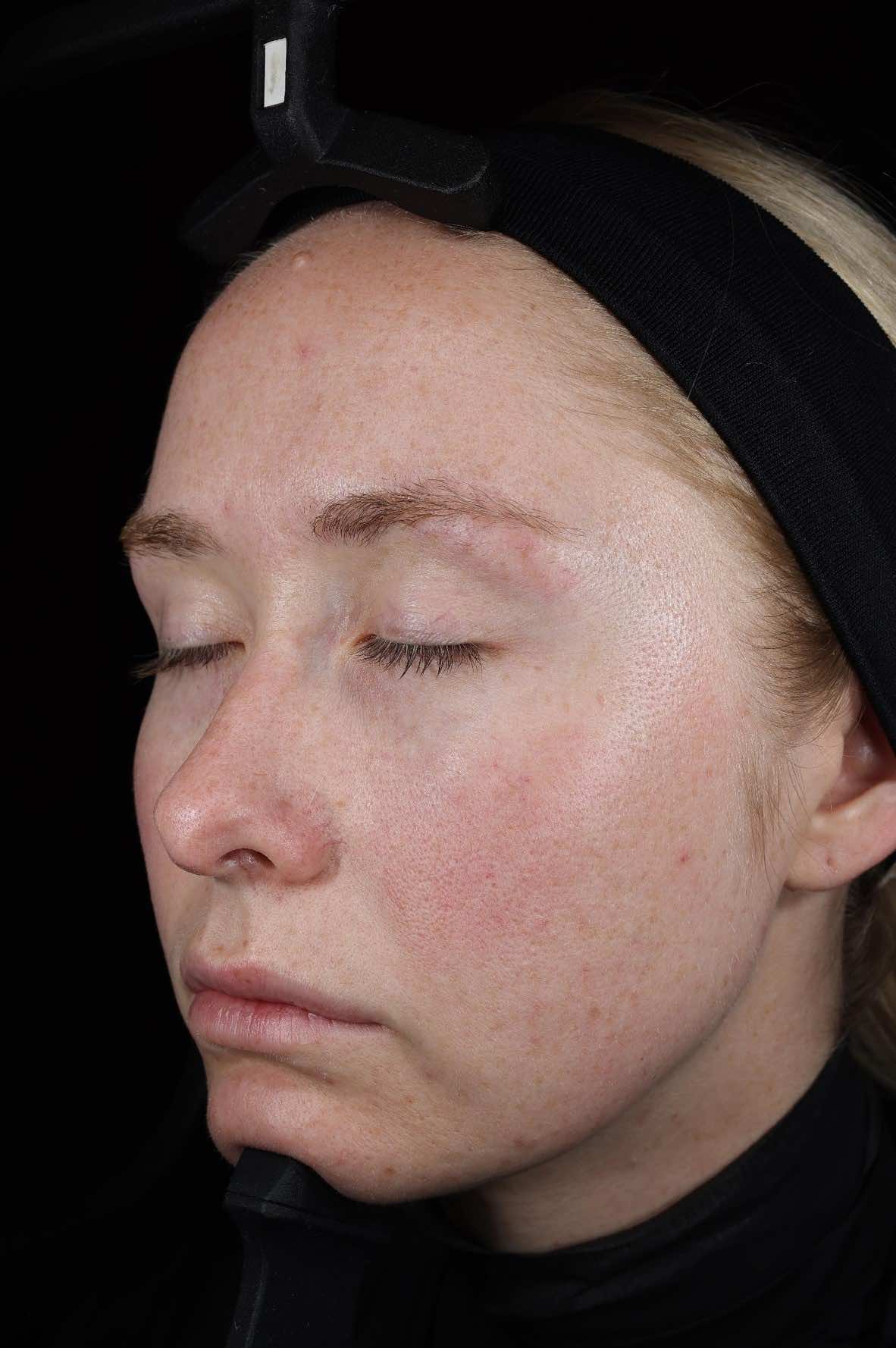 SkinPen treatment progress Vor